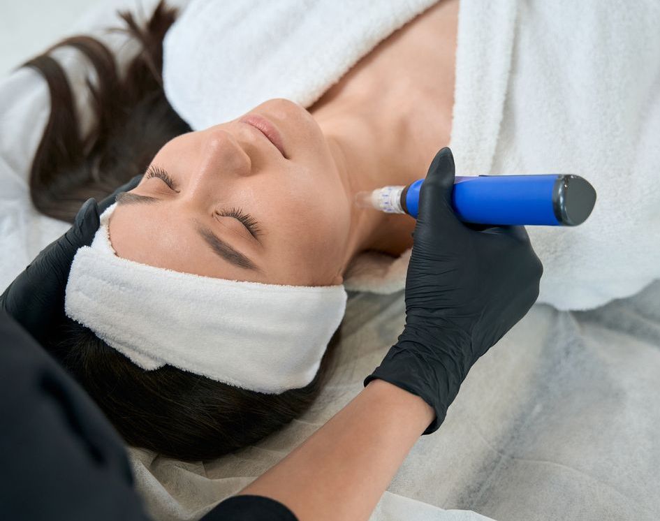 Microneedling